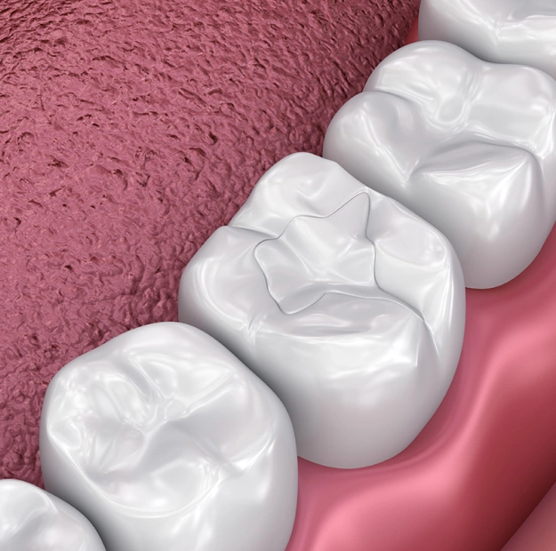 composite fillings